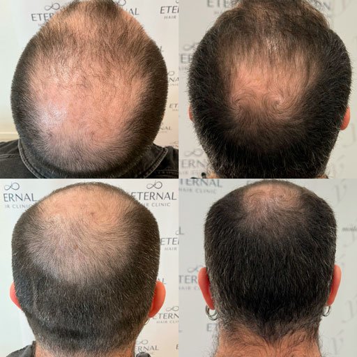 Evolución-capilar-en-alopecia-extensa-tratada-con-mesoterapia