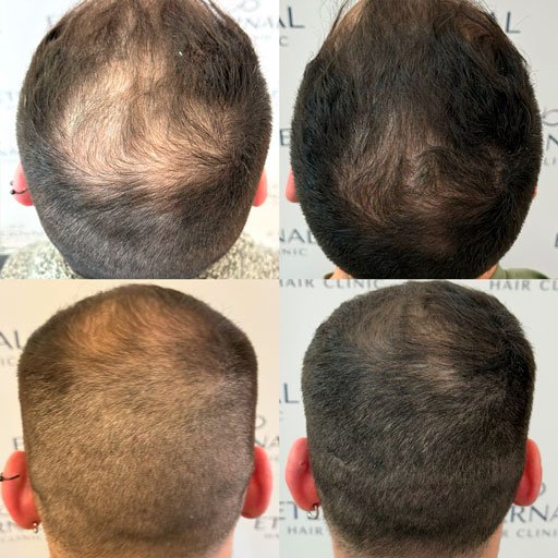Antes y después del tratamiento de mesoterapia capilar en coronilla de paciente joven con pérdida de densidad.