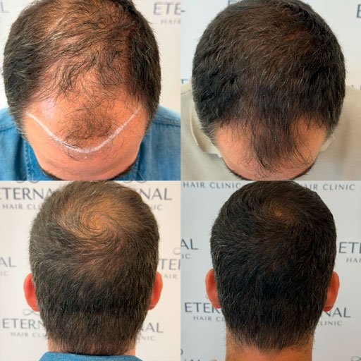 Tratamiento de mesoterapia capilar en entradas y coronilla con mejora progresiva en densidad capilar.