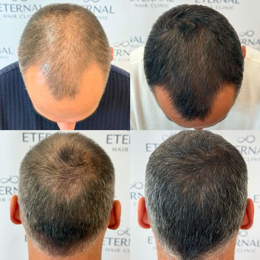 Evolución del cabello tras tratamiento de mesoterapia capilar en hombre con alopecia en entradas y coronilla.