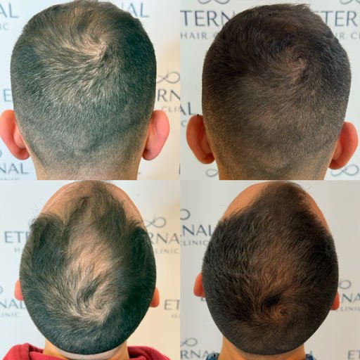 Resultados antes y después en paciente con alopecia en coronilla tratados con mesoterapia capilar en Barcelona.