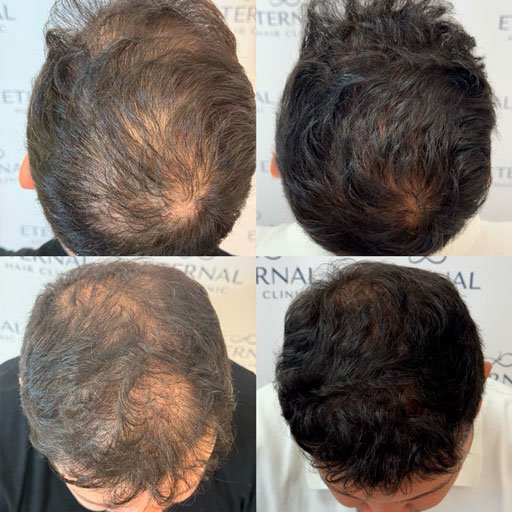 Antes y después de tratamiento con mesoterapia capilar mostrando aumento de densidad en entradas y coronilla.