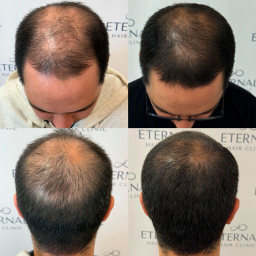 Aumento de densidad capilar en zonas de entradas y coronilla mediante mesoterapia capilar en Barcelona.