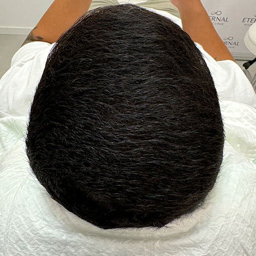 Resultado mesoterapia capilar en coronilla Barcelona