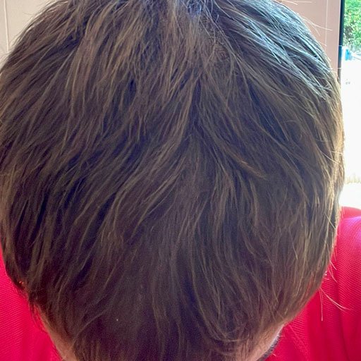 Resultado del tratamiento capilar de Gaizka en Eternal Hair Clinic Barcelona